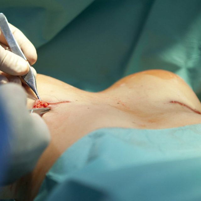 https://www.solis.sg/wp-content/uploads/2022/11/Precise_breast_cancer_surgery_now_available_here-640x640.jpg