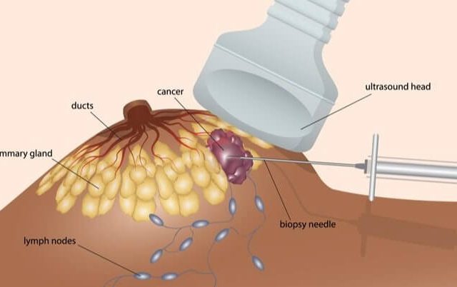 https://www.solis.sg/wp-content/uploads/2022/12/How-to-Prepare-for-a-Breast-Biopsy-640x402.jpg