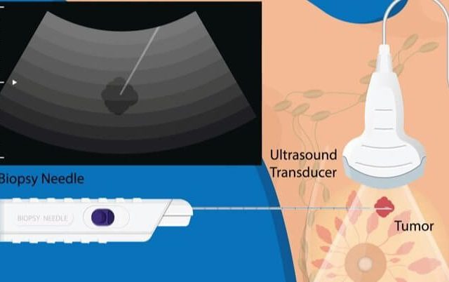https://www.solis.sg/wp-content/uploads/2022/12/The-future-of-breast-cancer-treatment-640x402.jpg