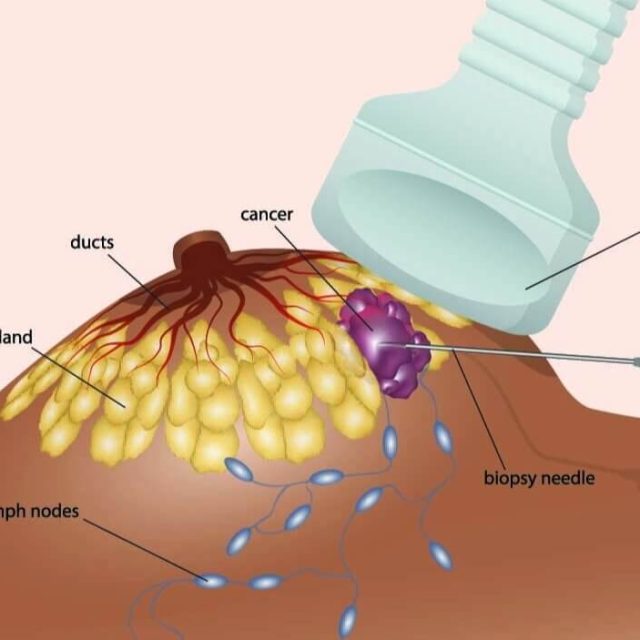 https://www.solis.sg/wp-content/uploads/2022/12/When-is-A-Breast-Biopsy-Needed-640x640.jpg