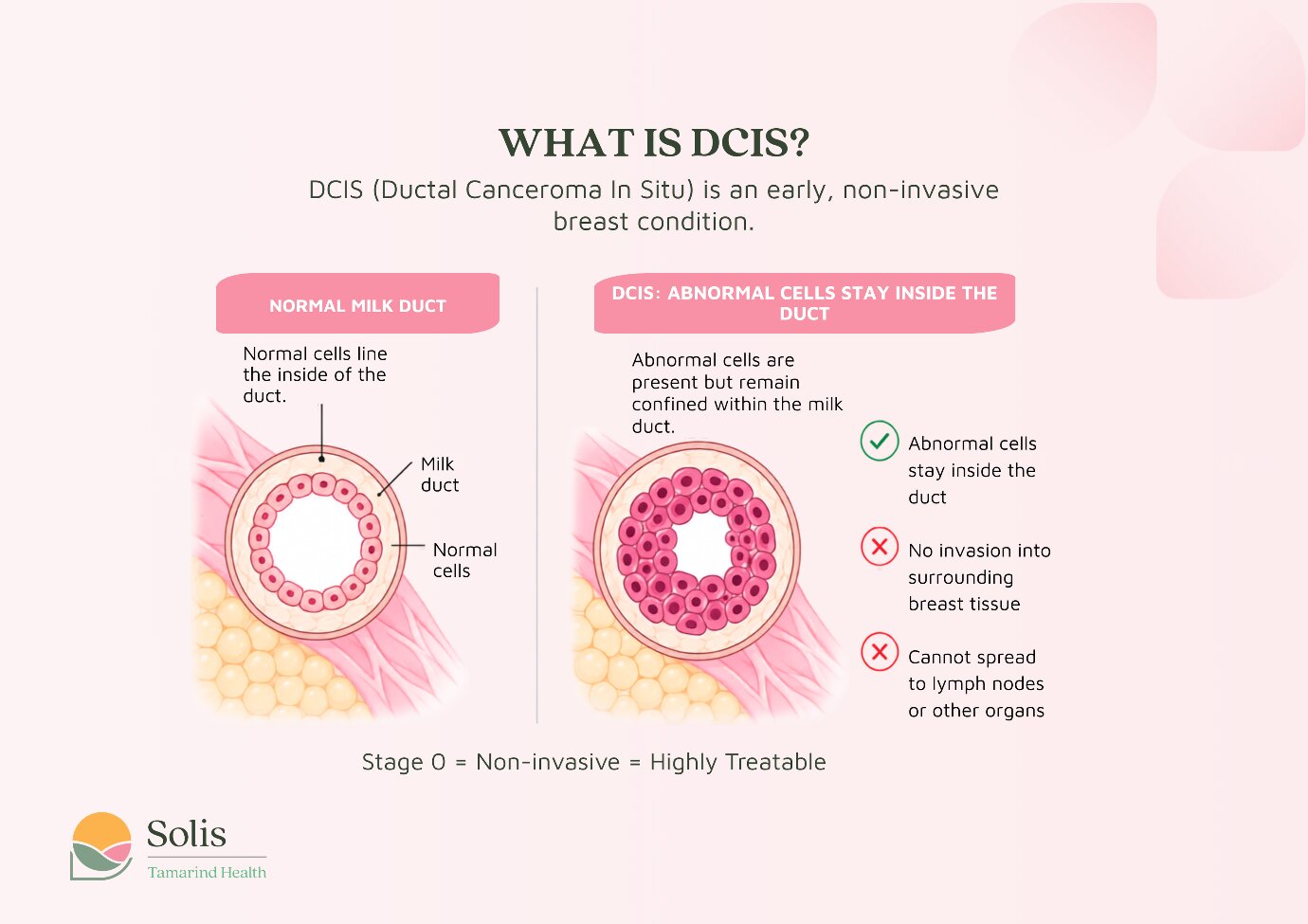 Infographic explaining DCIS: shows normal milk duct vs. abnormal cells inside duct, highlights that DCIS is an early stage breast cancer that is non-invasive and highly treatable, with no spread to lymph nodes or other organs.